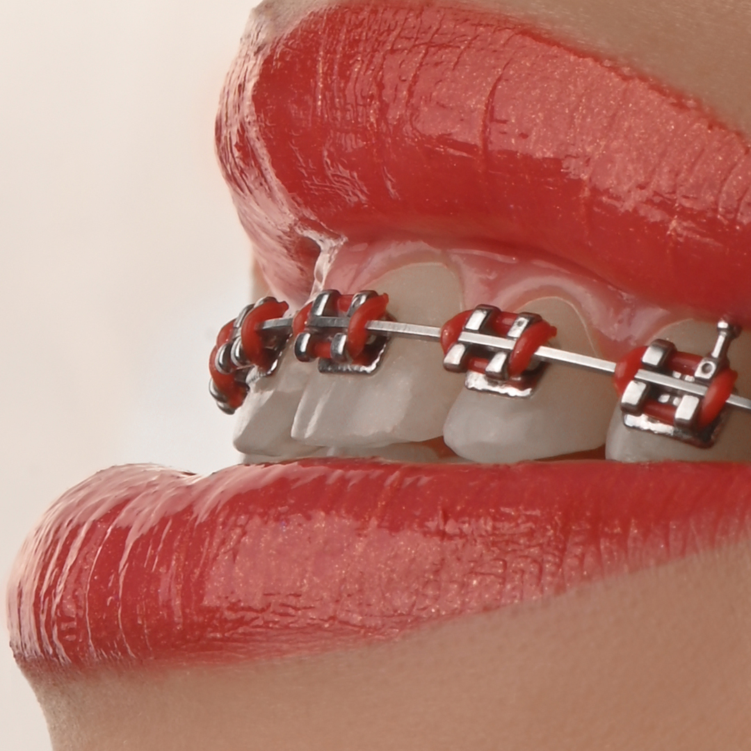 براکت فلزی American Orthodontics - 6