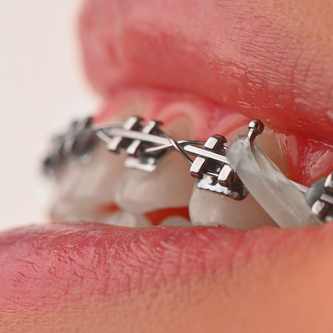 براکت فلزی American Orthodontics - 11
