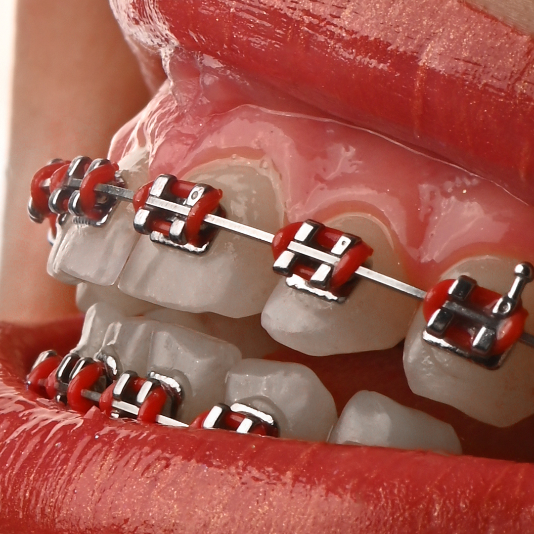 براکت فلزی American Orthodontics - 10