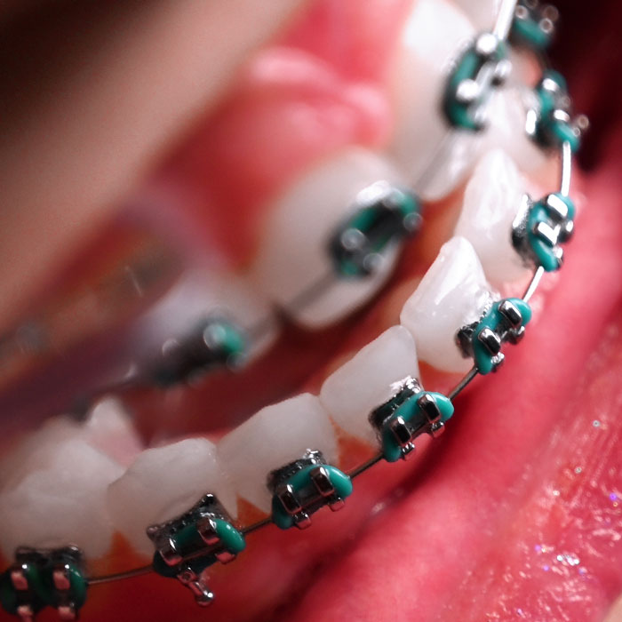 براکت فلزی American Orthodontics - 9