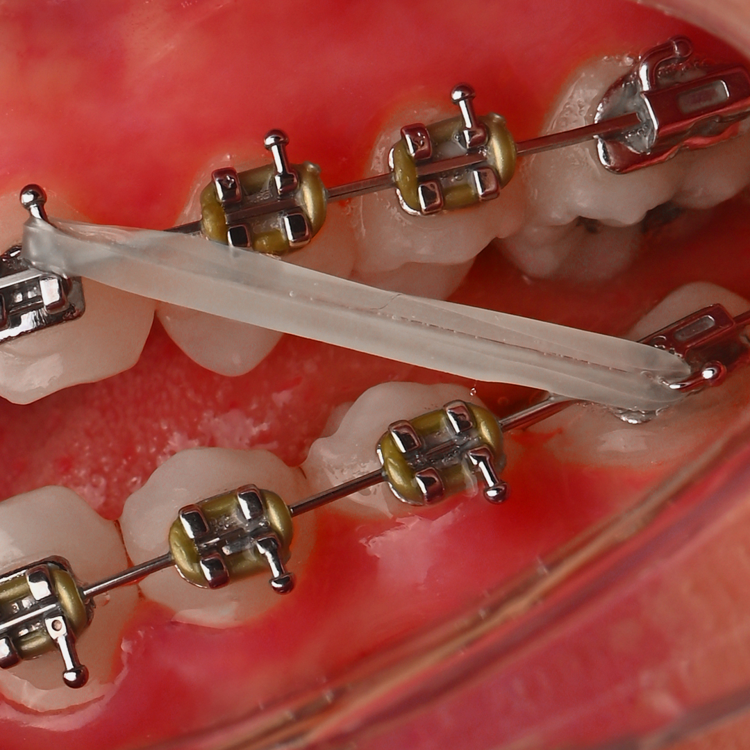 براکت فلزی American Orthodontics - 18