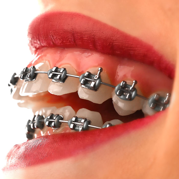 براکت فلزی American Orthodontics - 22