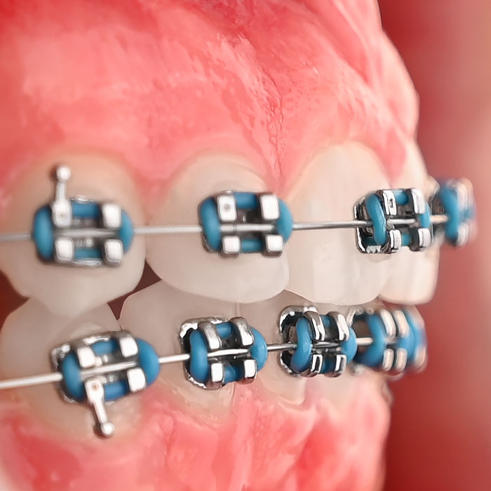 براکت فلزی American Orthodontics - 16