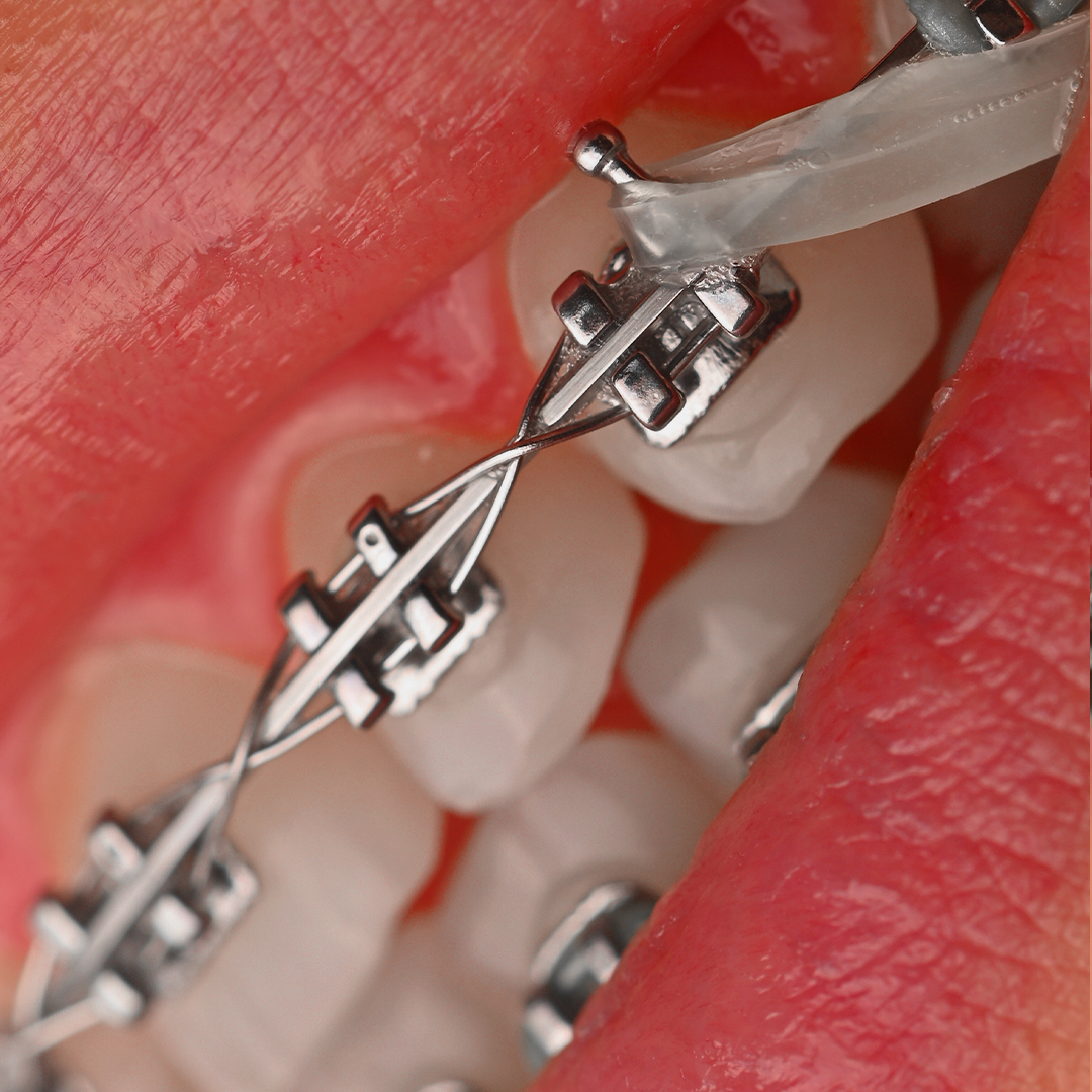 براکت فلزی American Orthodontics - 21