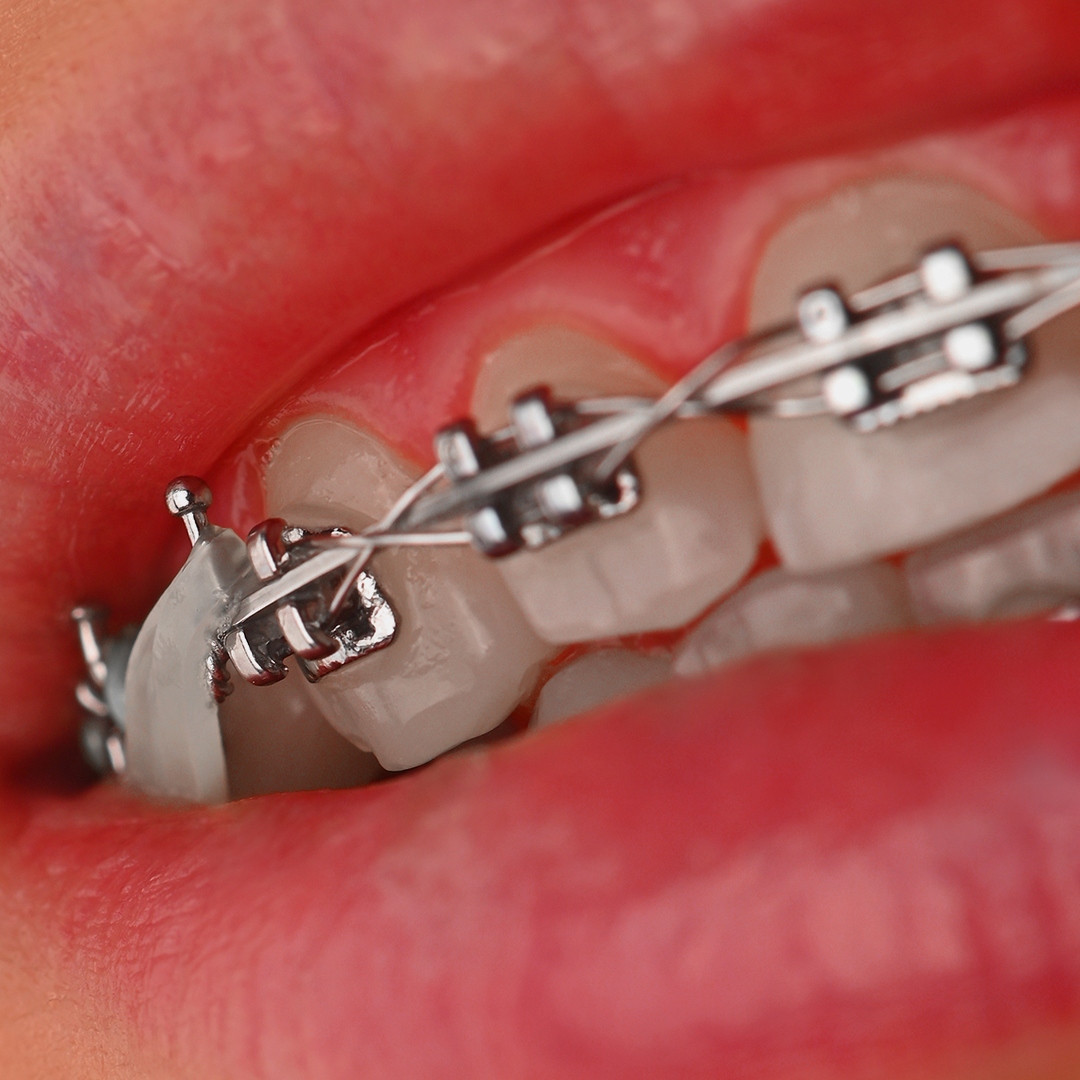 براکت فلزی American Orthodontics - 17