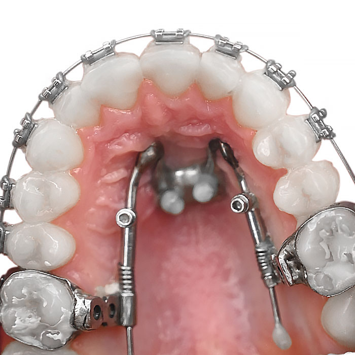 کیت دیستال جت American Orthodontics - 1