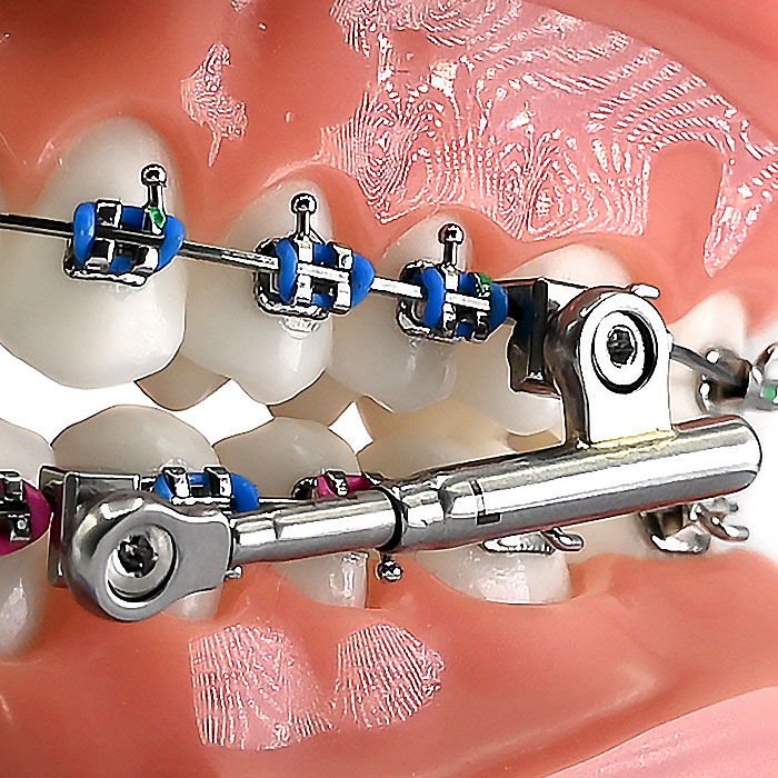 پاور اسکوپ 2 American Orthodontics - 5